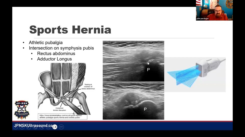 Athletic pubalgia：共同腱膜、站立誘發與掃描人體工學，41:48 的代表畫面