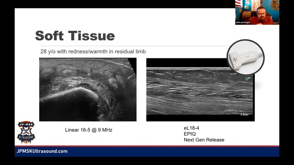 殘肢軟組織：bone spur、edema、bursa 與疑似感染，49:36 的代表畫面