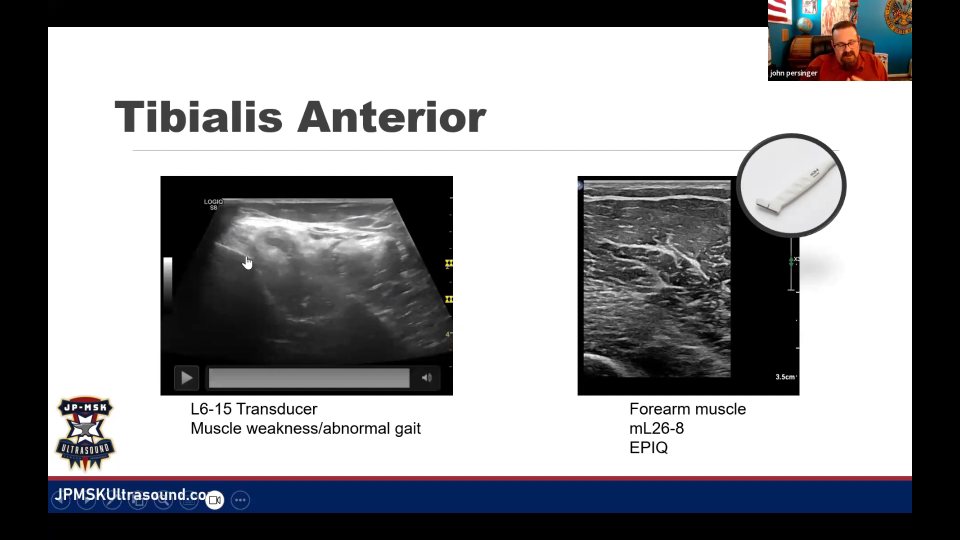 Tibialis anterior：功能不足與 fatty replacement，51:50 的代表畫面