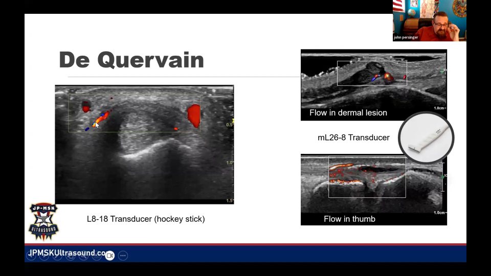 Ulnar nerve compression 與 de Quervain tenosynovitis，54:25 的代表畫面